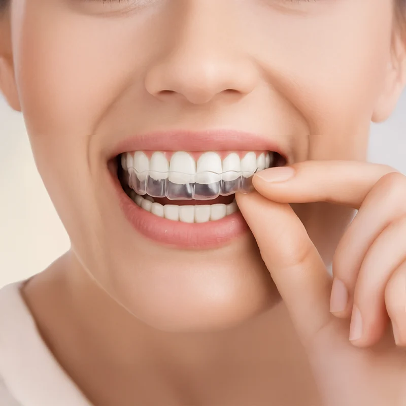 Aligner Zahnschiene Aligner Zahnschiene